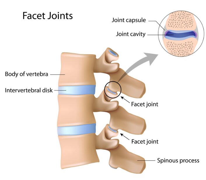 آلام أسفل الظهر الصادرة من المفاصل الصغيرة في العمود الفقري