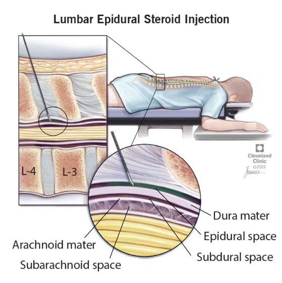 حقن الستيرويد (الكورتيزون) في العمود الفقري في أسفل الظهر