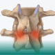 آلام أسفل الظهر الصادرة من المفاصل الصغيرة في العمود الفقري