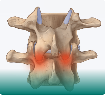 آلام أسفل الظهر الصادرة من المفاصل الصغيرة في العمود الفقري