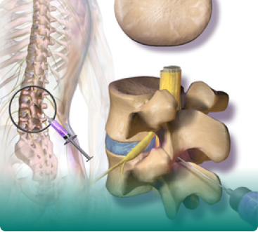 حقن الستيرويد (الكورتيزون) في العمود الفقري في أسفل الظهر