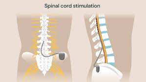Advanced Treatment – Spinal Cord Stimulation