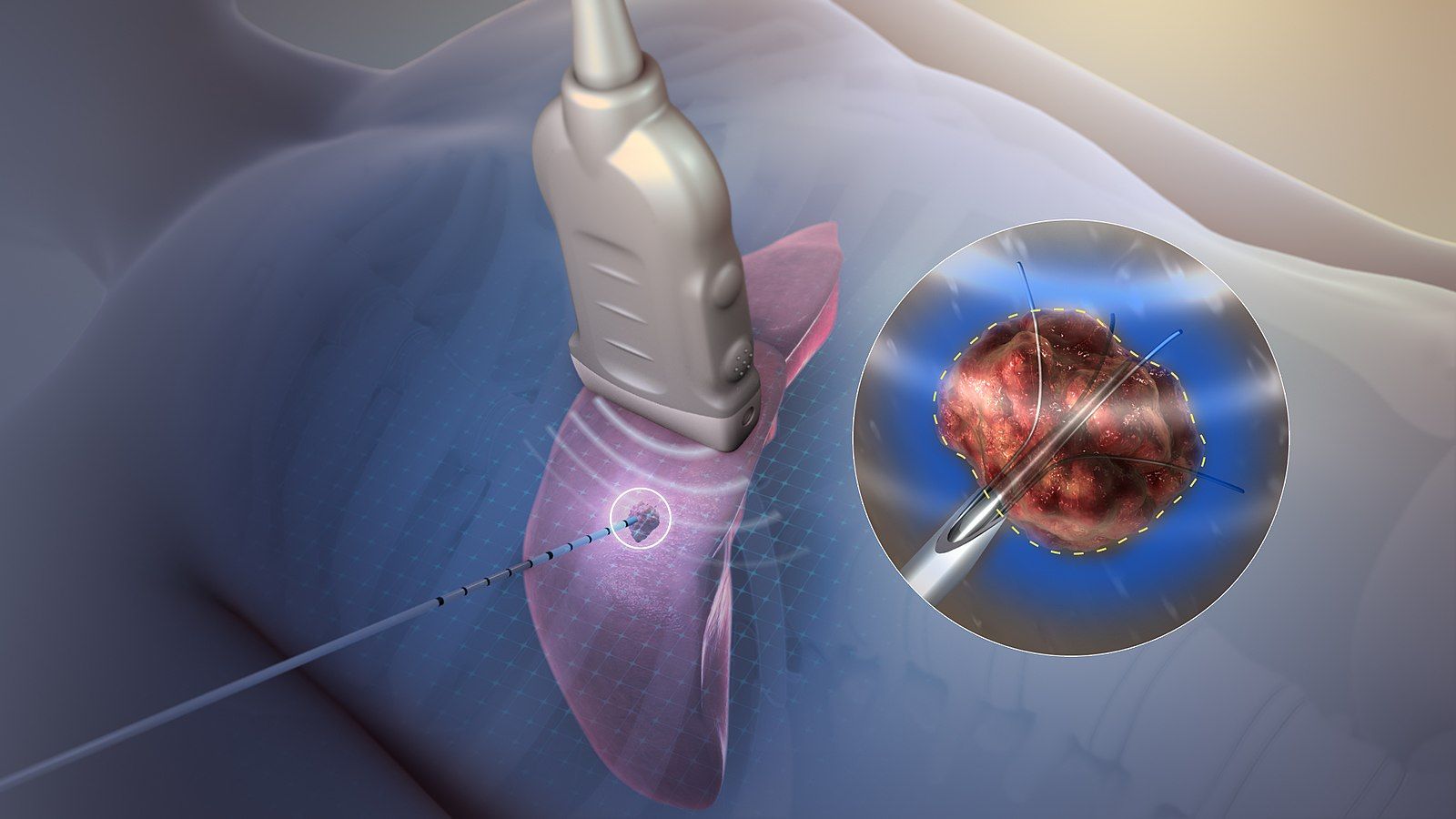 Radiofrequency Ablation For Pain Relief How It Works Radiofrequency Ablation For Pain Relief How It Works